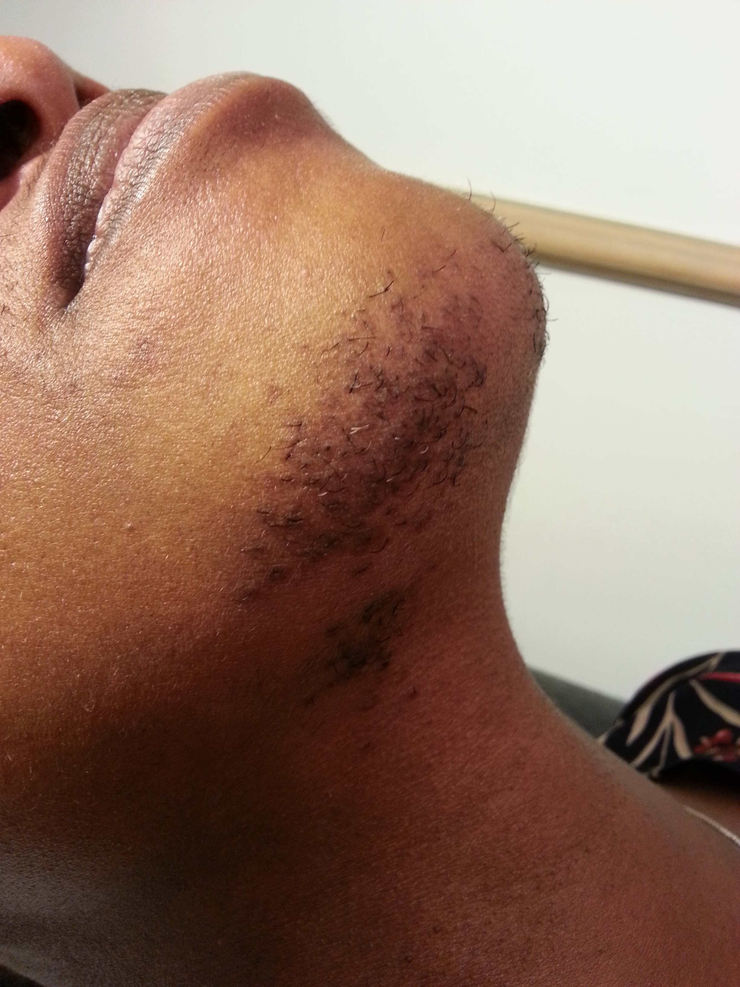 Ingrown hair damage caused by inexperienced electrologist